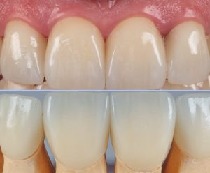 Dr.Klīnika 8 cirkonija keramikas kroņi