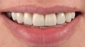 Dr.Klīnika 8 cirkonija keramikas kroņi