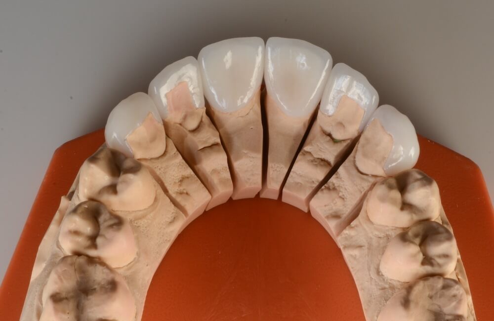 DR.Klīnika 6 keramiskās restaurācijas